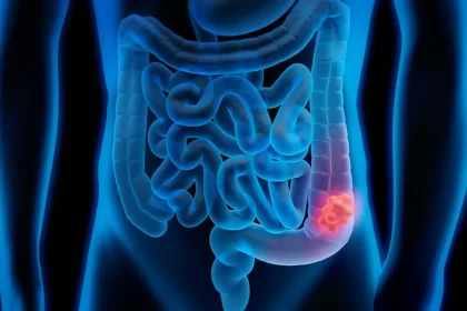 En Puebla en 2023 aumentaron las defunciones por cáncer: INEGI