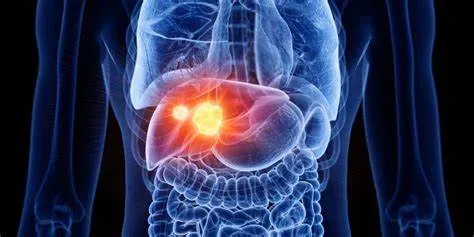 Alcohol está detrás del 30 por ciento de los casos de cáncer de hígado ¿Otra copita?
