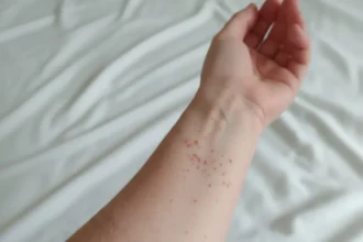 1er caso de sarampión en Puebla