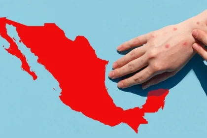 Brote de sarampión en México