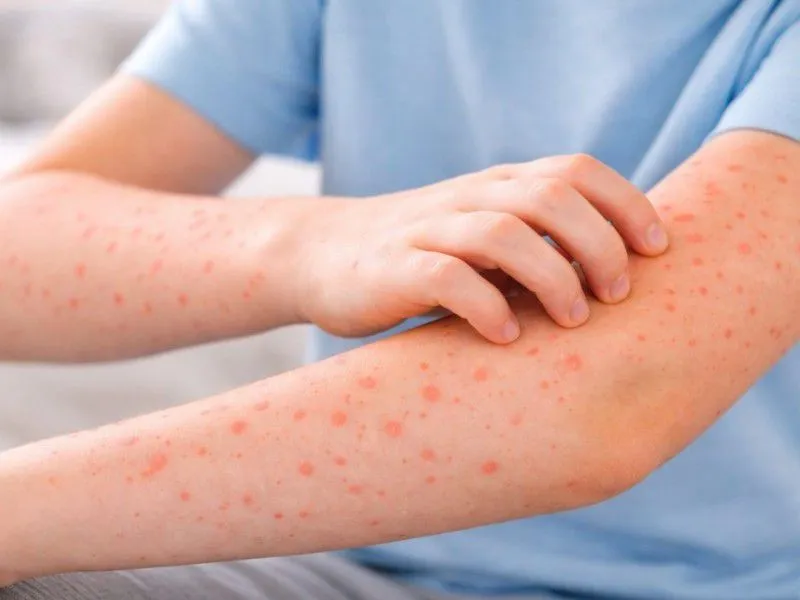 Disminuyen contagios de sarampión en Puebla