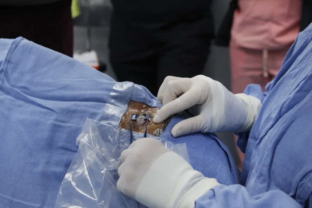 Realiza Hospital de Especialidades del IMSS Puebla trasplante de córnea